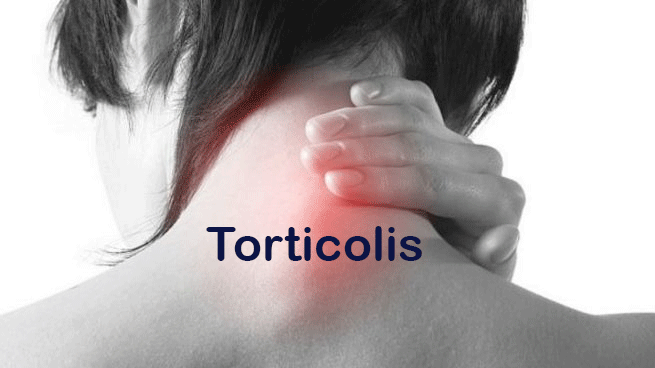 Torticolis